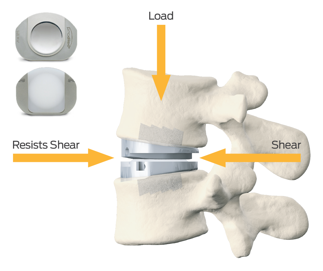 disc replacement designed to resist shear forces