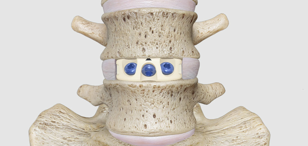 spinal fusion