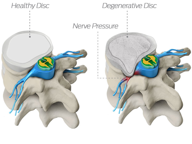 healthy and degenerated disc