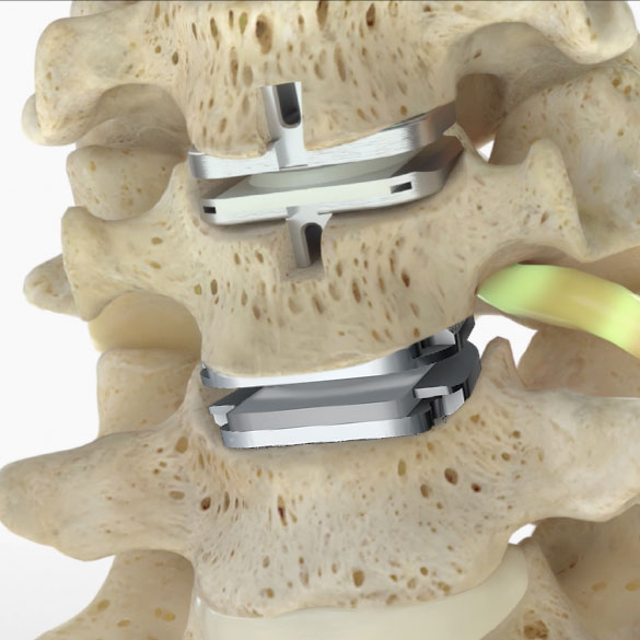 cervical disc replacement clinical study