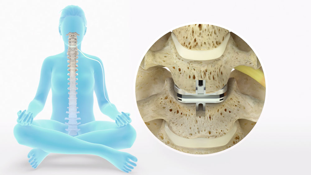 cervical disc replacement explainer