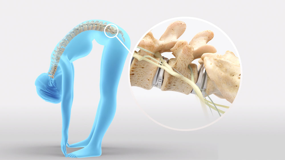 lumbar disc replacement explainer